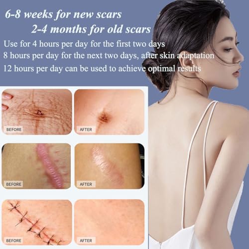 Medical-Grade Silicone Scar Sheets 1.6"x 118" Roll for Scar Treatment