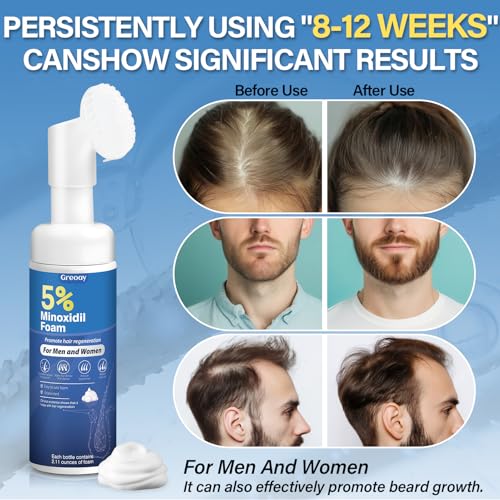 5% Minoxidil Hair Growth Foam for Thinning Hair - 2.11 oz