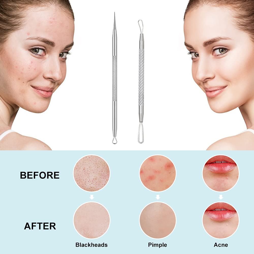 Professional Blackhead and Blemish Remover -Pimple Comedone Removal 2-in-1 Extractor Tool -by La Chat (2 Packs)