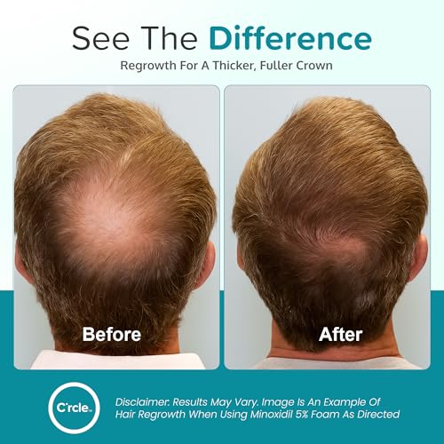 Minoxidil for Men Foam 5% - Unscented 3 Month Supply - Helps Restore Vertex Hair Loss & Thinning - 5% Minoxidil Foam For Men - Extra Strength Supports Hair Regrowth