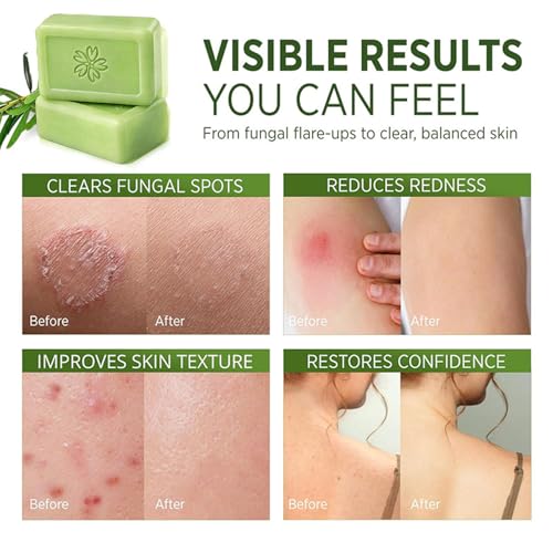 Glo7 Ironbark Antifungal Soap Bar for Athlete's Foot - Tea Tree Oil Relief
