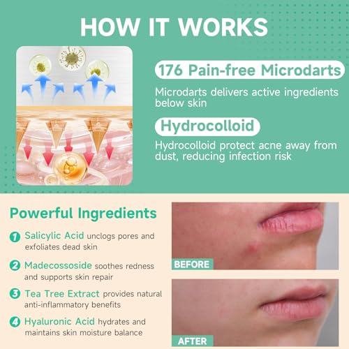 TEAWOO Microdart Acne Patches - 18 Hydrocolloid Patches with Salicylic Acid