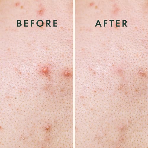Rael Miracle XL Hydrocolloid Pimple Patches - 8 Ct for Large Blemishes