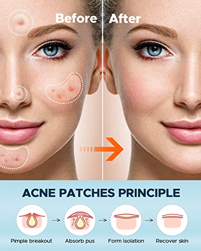 LitBear Large Acne Pimple Patches - 100 Count Hydrocolloid Stickers