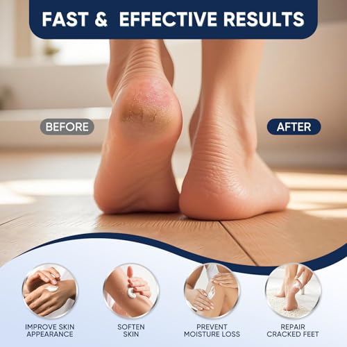 VREKEF 60% Urea Cream with Salicylic Acid for Cracked Heels & Callus Removal