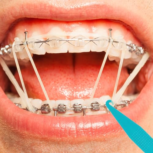 30 Pcs Disposable Rubber Bands Placers for Braces - Multicolored
