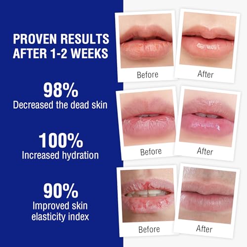OUKEYA Medicated Lip Balm for Dry Chapped Lips, 24H Hydrating Repair