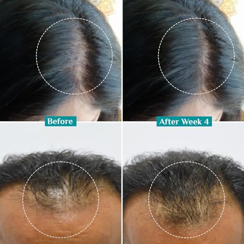 Pilgrim Hair Growth Serum 1.01 Fl Oz with Redensyl & Baicapil for Men & Women – Includes Pack of 1