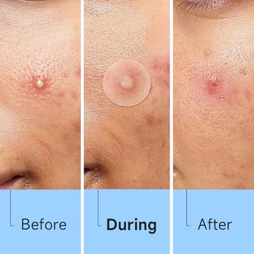 Glowpatch Pimple Patches - 840 Hydrocolloid Zit Stickers in 4 Sizes
