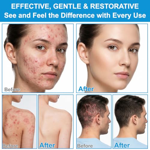Lofuanna Follicle Cream for Ingrown Hair Relief - Non-Greasy Formula
