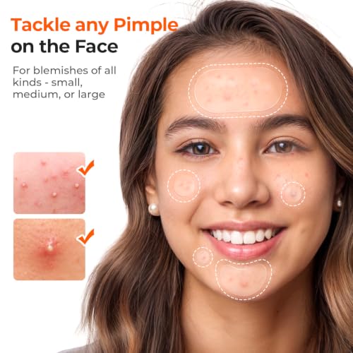 TKTK Hydrocolloid Pimple Patches - 609 Count Variety Pack for Acne Treatment