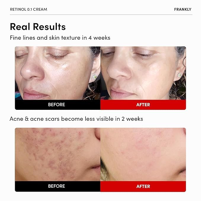 FRANKLY Retinol 0.1% Cream - Anti-Aging Night Cream with Ceramides & Ginseng