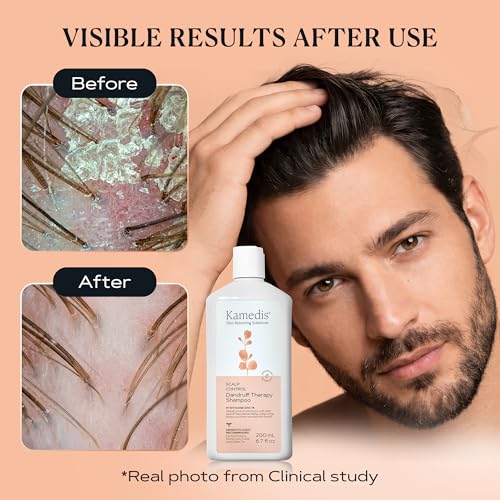 KAMEDIS Scalp Savior 6.7 Fl Oz - Itchy Dry & Dandruff Relief Shampoo
