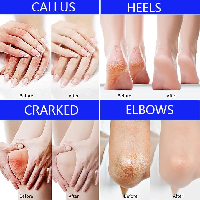 Urea Foot Cream 40% for Cracked Heels – Intensive Moisturizing Lotion 5.29 fl oz