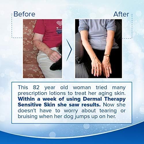 Dermal Therapy Sensitive Skin Lotion with Allantoin & Shea Butter