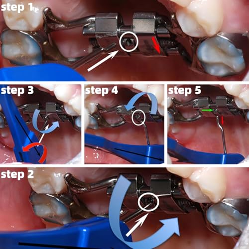 Orthodontic Palatal Expander Keys - 3 Pack Swivel Turning Tools