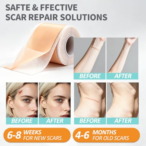 Anchiray Medical Grade Silicone Scar Tape Roll - 1.6" x 60" Waterproof
