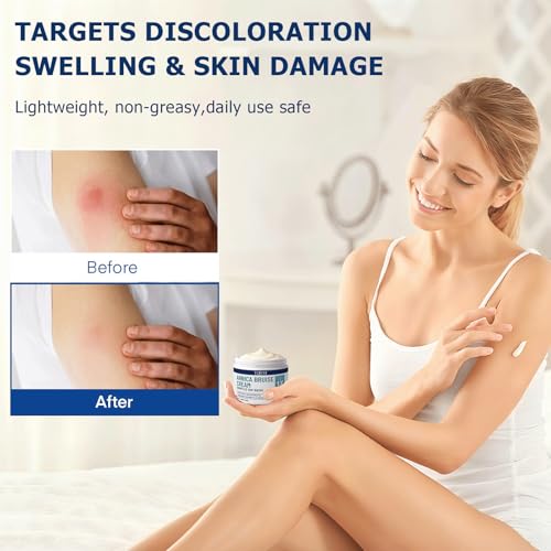 Extra Strength Arnica Bruise Cream 1pcs - Soothing & Hydrating