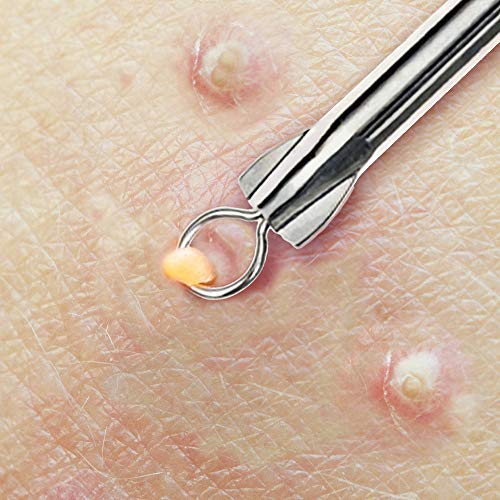 Beaute Galleria Blackhead & Acne Pimple Extractor Tool - Skin Blemish Remover