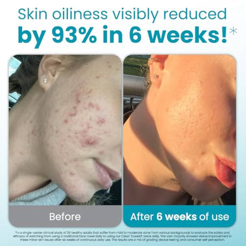 Blemish Control Face Towels XL - Travel Pack of 30 for Oily Skin