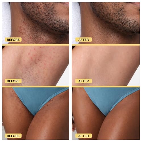 BASE LABORATORIES Ingrown Hair Treatment Oil ? Soothing After Shave Oil Prevents Ingrown Hairs, Soothes Razor Bumps for Bikini Area, Legs, Underarms, Neck, Beard & Face ? Tea Tree, Jojoba 1oz (30ml)