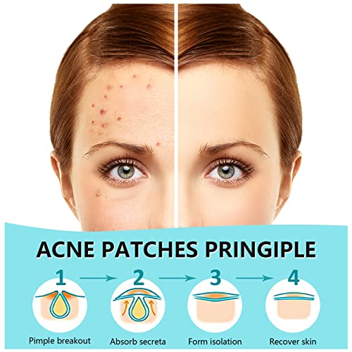 180 Hydrocolloid Acne Patches for Fast Pimple Treatment
