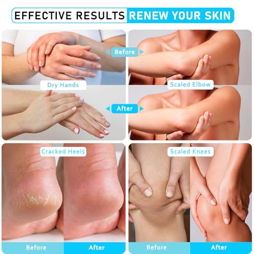 Aphesia Urea 40% Foot Cream - Deep Moisturizing, 5.3 Fl Oz