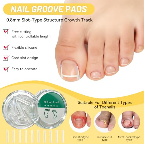 Ingrown Toenail Treatment Kit - Painless Home Care Set