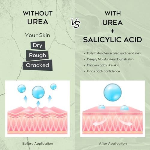 Vebuni Urea 42% Foot Cream with Salicylic Acid for Callus Removal & Moisturizing