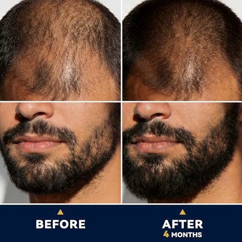 LUROUKED 5% Minoxidil Spray for Men - Beard and Hair Growth Treatment