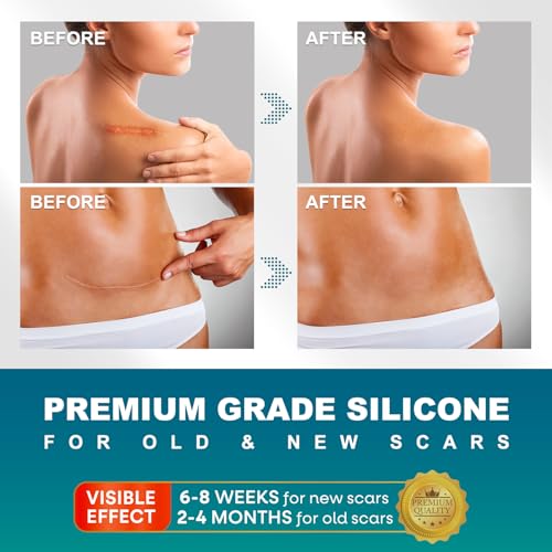 UNIEDI Silicone Scar Sheets - 1.6" x 120" Roll for Surgical & Keloid Scars