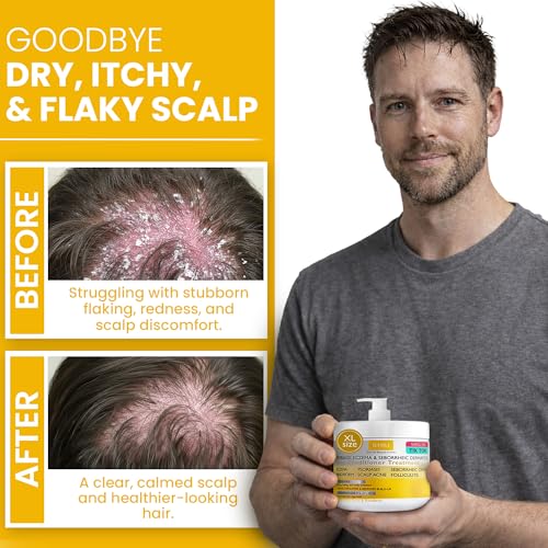 Rida Hair Research Institute Anti Fungal Psoriasis Conditioner for Scalp Relief – After Shampoo