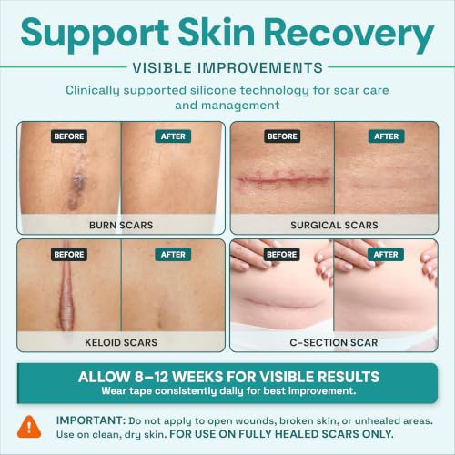 Silicone Scar Tape & Sheets for Surgical Scars | Medical Grade