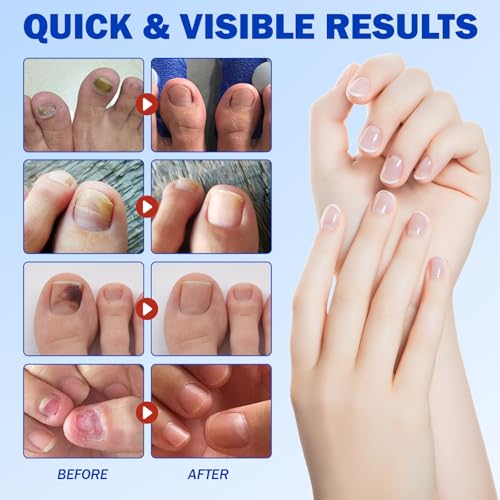 FANSHI 21 PCS Nail Patches - Extra Strength Overnight Repair for Damaged Nails