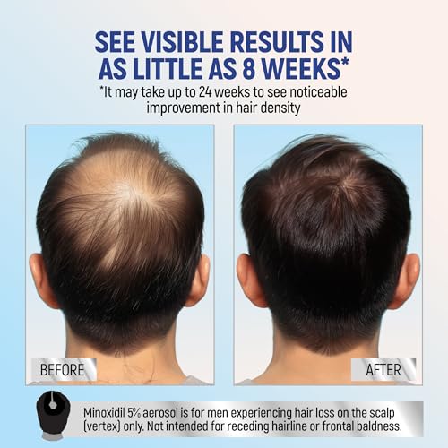 Minoxidil 5% Topical Aerosol Foam, Hair Regrowth 4 Months Treatment for Men, 2.11 oz (4 Pack)