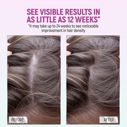 Minoxidil for Women, 2.11 Oz (2 Months Supply) Clinically Proven to Regrow Hair, Topical Aerosol Foam 5%, Hair Thinning Treatment