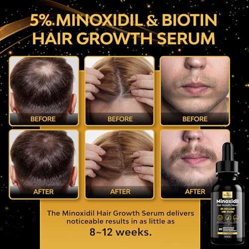 beaueli 5% Minoxidil for Men & Women Hair Growth, Beard Growth, Hair Loss Treatment, Unisex Adult 1oz