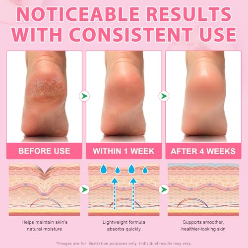 Urea Foot Callus Remover Stick - Moisturizing Heel & Skin Softening Treatment