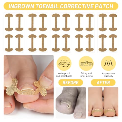 Ingrown Toenail Treatment Kit - Painless Home Care Set