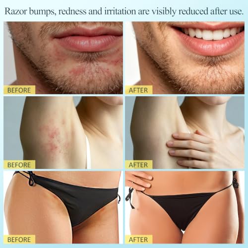 Ingrown Hair Exfoliating Scrub with AHA & BHA - KP Bump Eraser