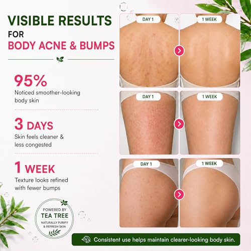 BellamiLuxx Tea Tree Body Acne Soap Bar for Bumps & Folliculitis