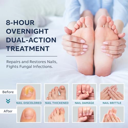 OSIMOON Toenail Fungus Treatment Kit: Nail Repair Solution & Night Patches