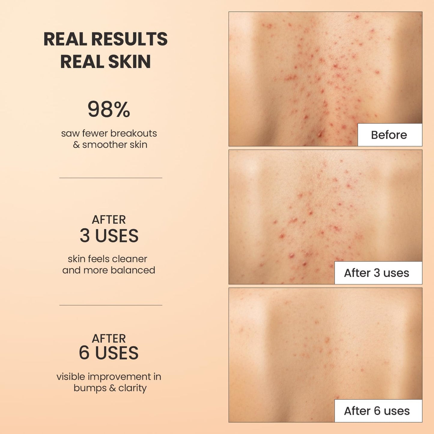 Body Acne Treatment Scrub - Reduce Breakouts on Back, Chest, & Thighs | Natural Actives for Smooth Skin