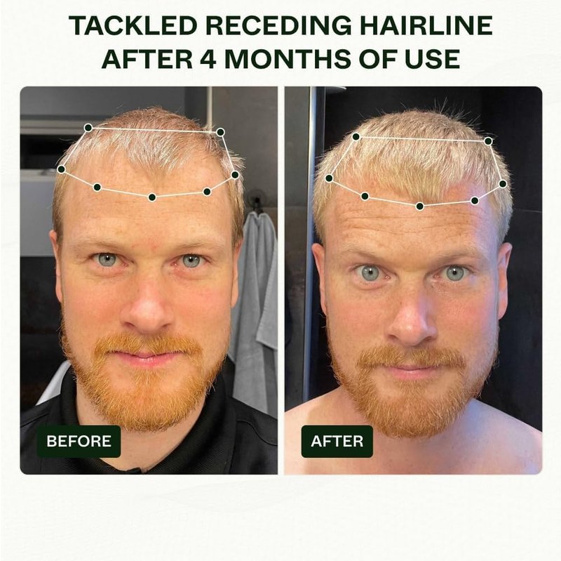 Scandinavian Biolabs Bio-Pilixin® Routine For Men | Helps With Hair Shedding, Nurtures Hair Follicles, Enhances Hair Strength, Repairs Damaged Hair, Clinically Tested, Dermatologically Approved