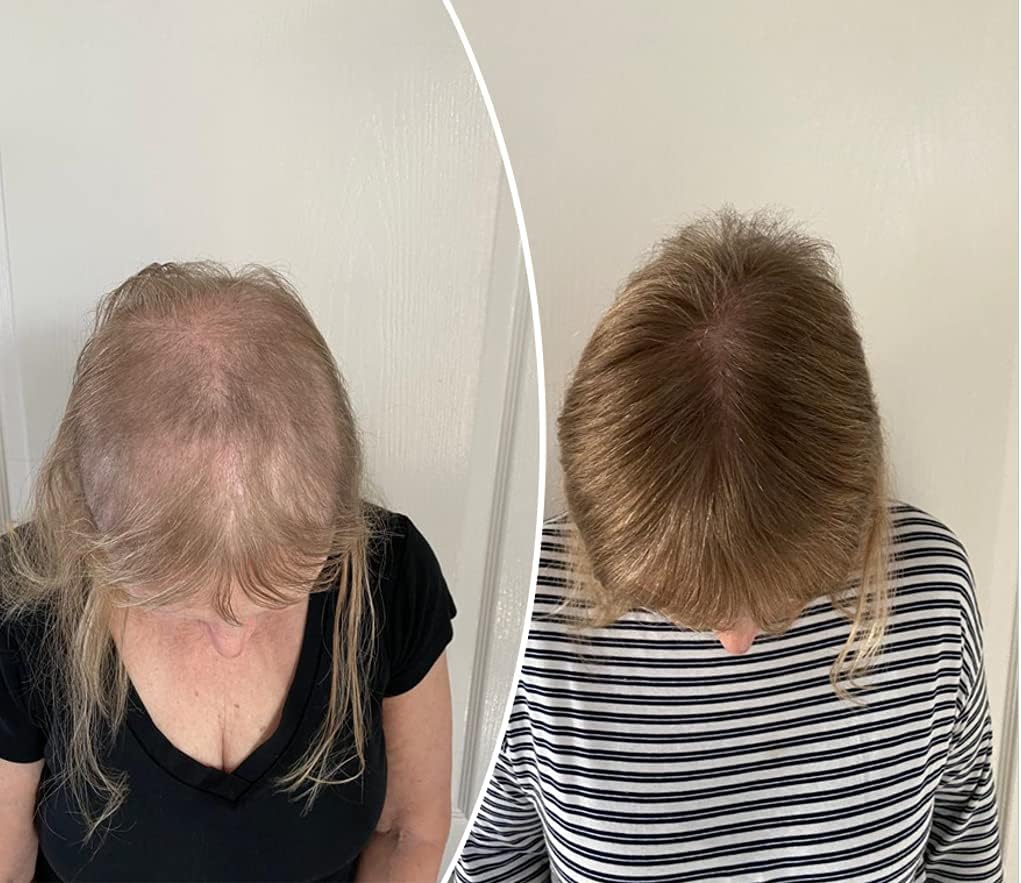 Hair Growth Serum | 7-Week Regrowth Kit with Biotin, Caffeine & Peptides for Thinning Hair - 5x5mL