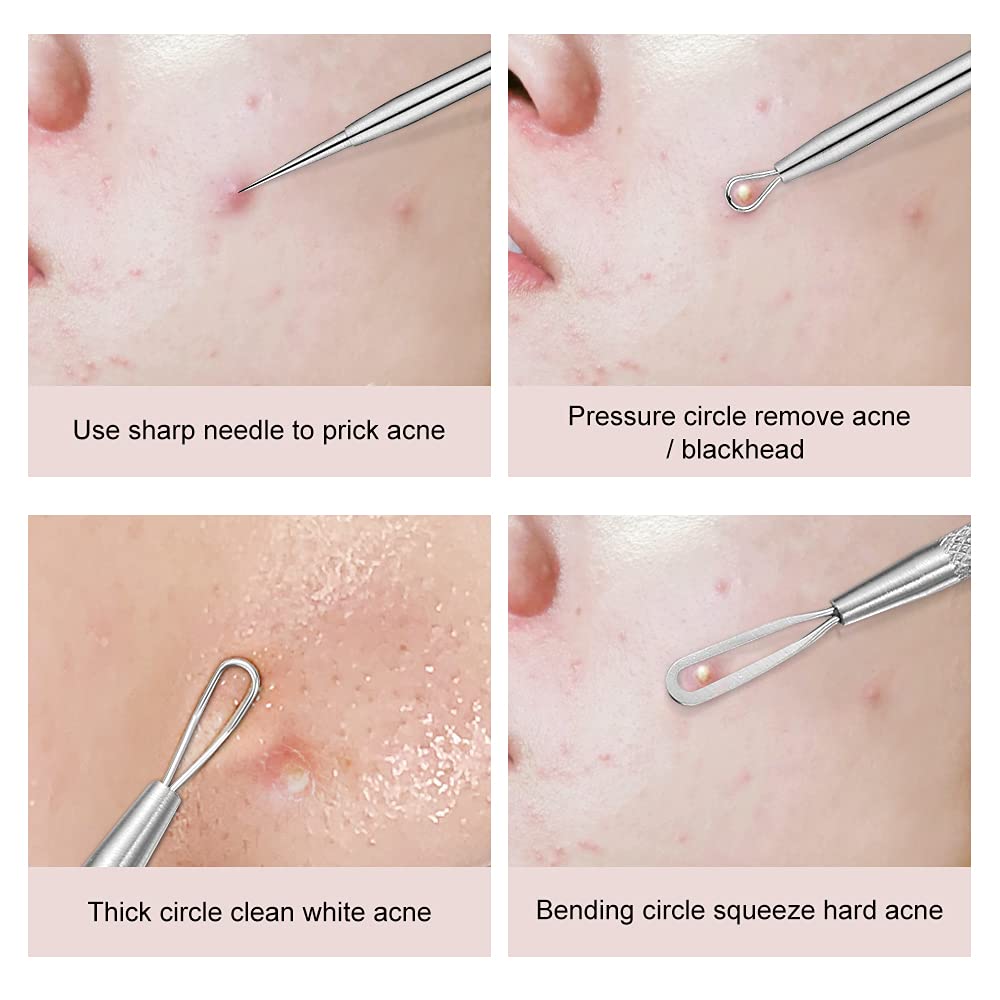 Professional Blackhead and Blemish Remover -Pimple Comedone Removal 2-in-1 Extractor Tool -by La Chat (2 Packs)