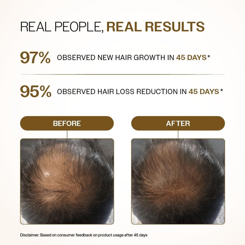 Advanced Hair Density Roll-On | 3% Redensyl, 4% Anagain, 2% Baicapil & Rosemary | Reduces Hair Fall & Supports Growth | 25ml