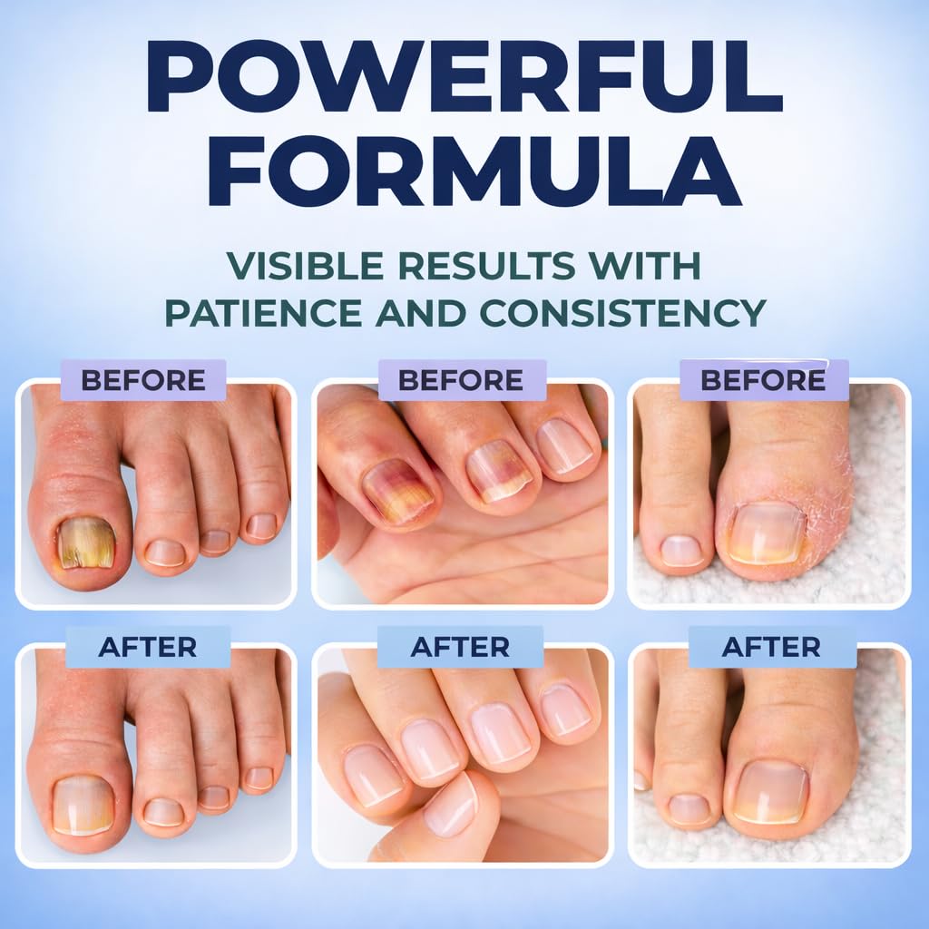 Toenail Fungus Treatment Pen - Extra Strength with 25% Undecylenic Acid | Nail Strengthener for Discolored & Ingrown Nails
