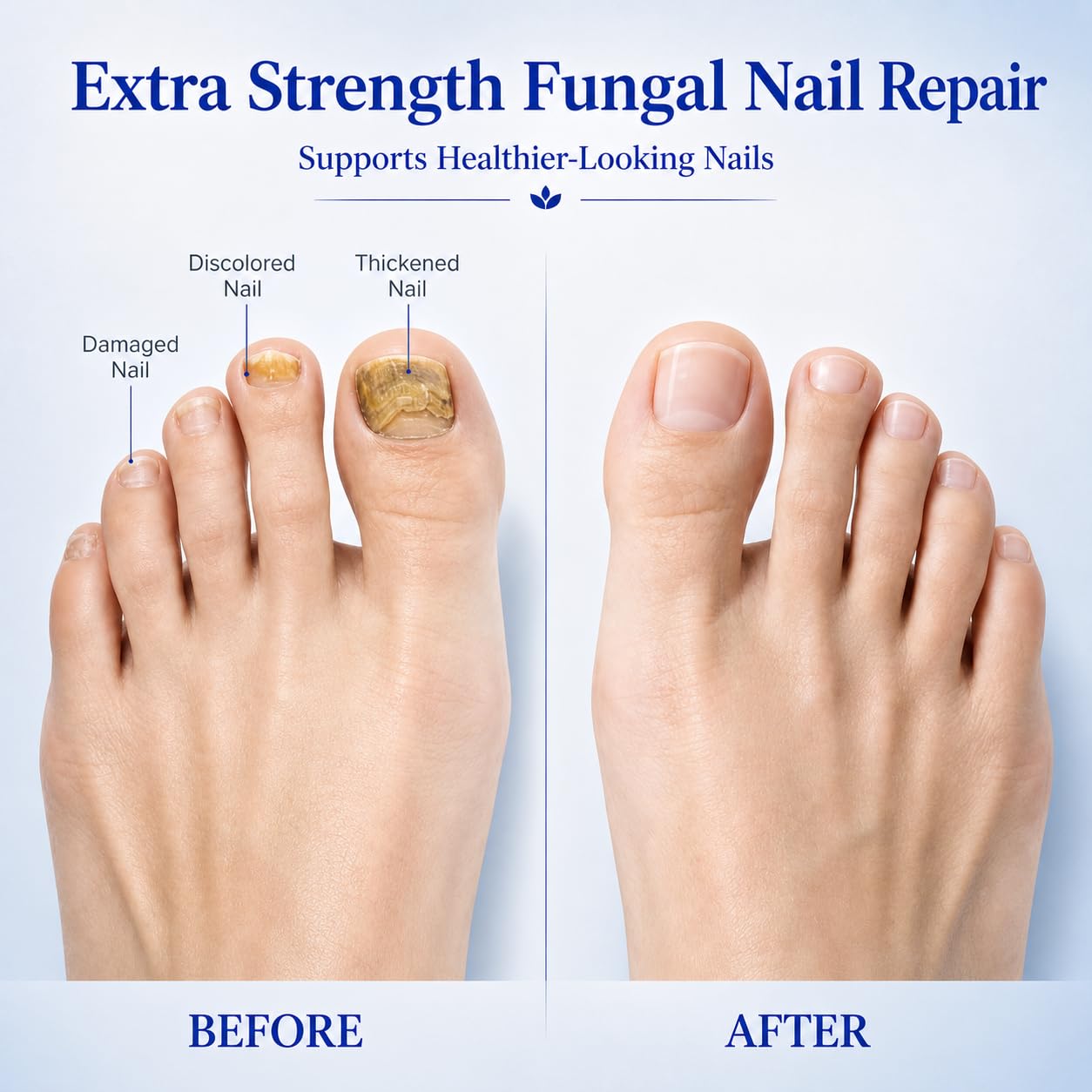 Lyssera Toenail Fungus Treatment Pen: Extra Strength 25% Undecylenic Acid & Tea Tree Oil - Fungal Nail Treatment for Thick Yellow Brittle Toenails and Fingernails, 4 PCS