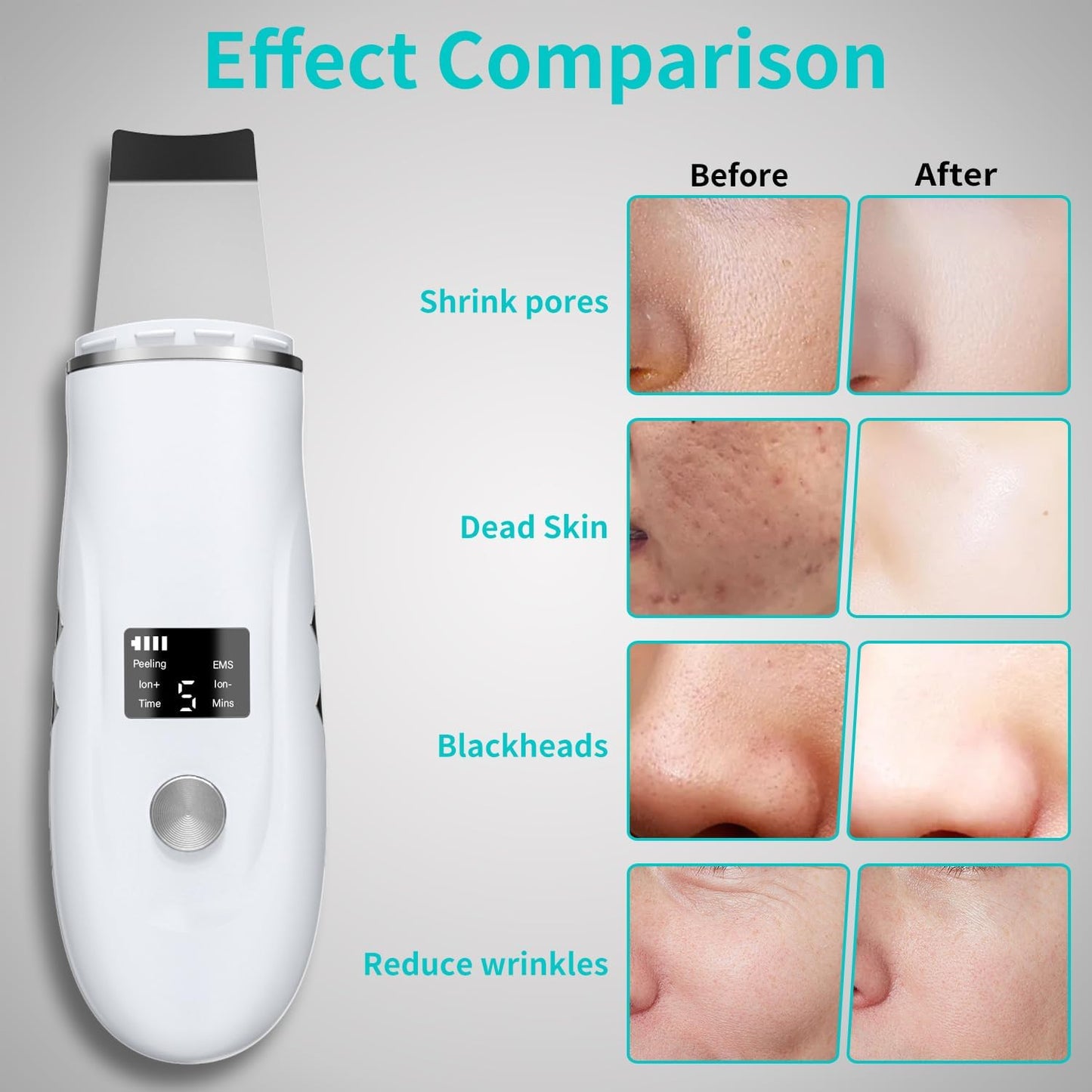 Face Scrubber Skin Spatula - 4-in-1 Blackhead Remover Tool for Deep Cleansing | Fast Charging Dock Included, White